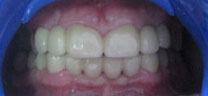 Cosmetic Dentistry - After