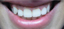 Cosmetic Dentistry - After