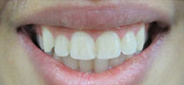 Cosmetic Dentistry - Before