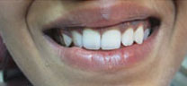 Cosmetic Dentistry - Before