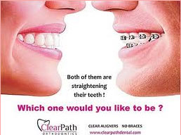 Clear Aligners Invisible Braces