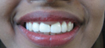 After - Laser Gum Lift