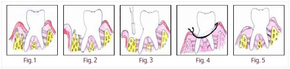 Gum Treatment