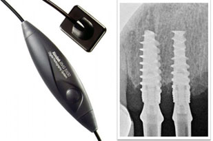 Digital RVG X-rays