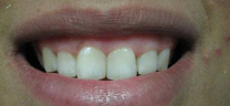 Before - Laser Gum Lift