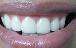 After - Laser Gum Lift