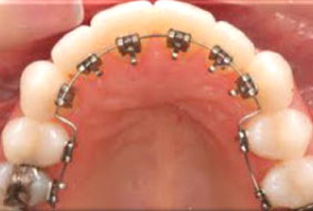 Lingual Braces