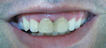 Before - Laser Gum Lift