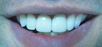 After - Laser Gum Lift