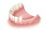 Multiple Teeth Implants