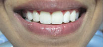 Smile Makeover with Laser Gum Lift - After