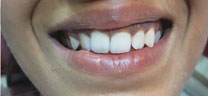 Smile Makeover with Laser Gum Lift - Before