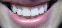 Laser Gum Lift - Before