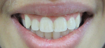 Laser Gum Lift - After