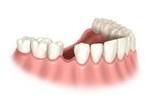 Single Tooth Implant