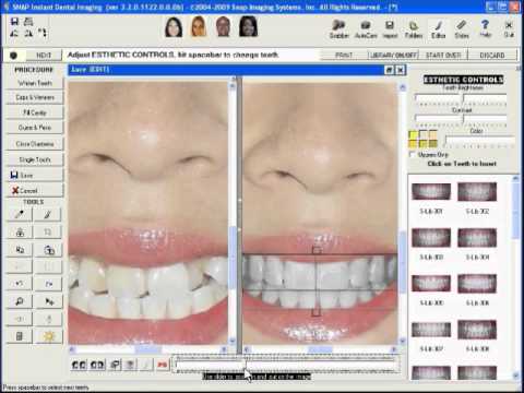 smile makeover virtual dental imaging snap software