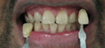 Zoom Whitening - Before