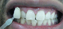 Zoom Whitening - After