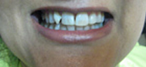 Mottling of Teeth Correction - Before