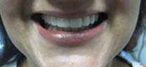 Mottling of Teeth Correction - After