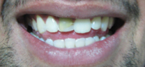 Cosmetic Tooth Colored Fillings - Before