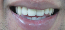 Cosmetic Tooth Colored Fillings - After