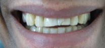 Cosmetic Tooth Colored Fillings - Before