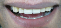 Cosmetic Tooth Colored Fillings - After