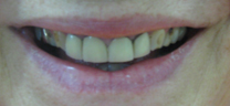 Laser Gum Lift - Before