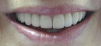 Laser Gum Lift - After