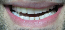 Crooked Tooth Correction
