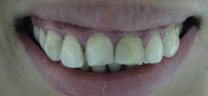 Before - Laser Gum Lift