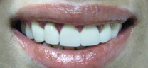 After - Laser Gum Lift