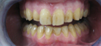 1 hr Zoom Advanced Teeth whitening - Before