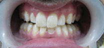 1 hr Zoom Advanced Teeth whitening - After