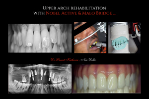 Upper Arch Rehabilation