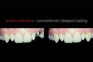 Anterior Esthetics