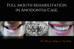 Full Mouth Rehabilitation In Anodontia Case
