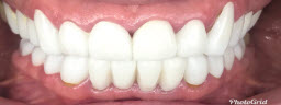 Mottling of Teeth Correction - After