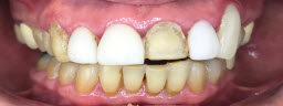 Mottling of Teeth Correction - Before