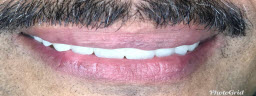 Smile Makeover with Metal Free Crowns - After