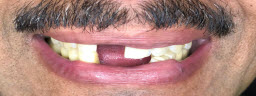 Smile Makeover with Metal Free Crowns - Before