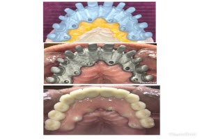 Dental Implants with Malo Bridge - Small