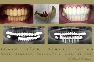 Lower Arch Rehabilitation with 6 Nobel Biocare Implants & Malo Bridge - Small