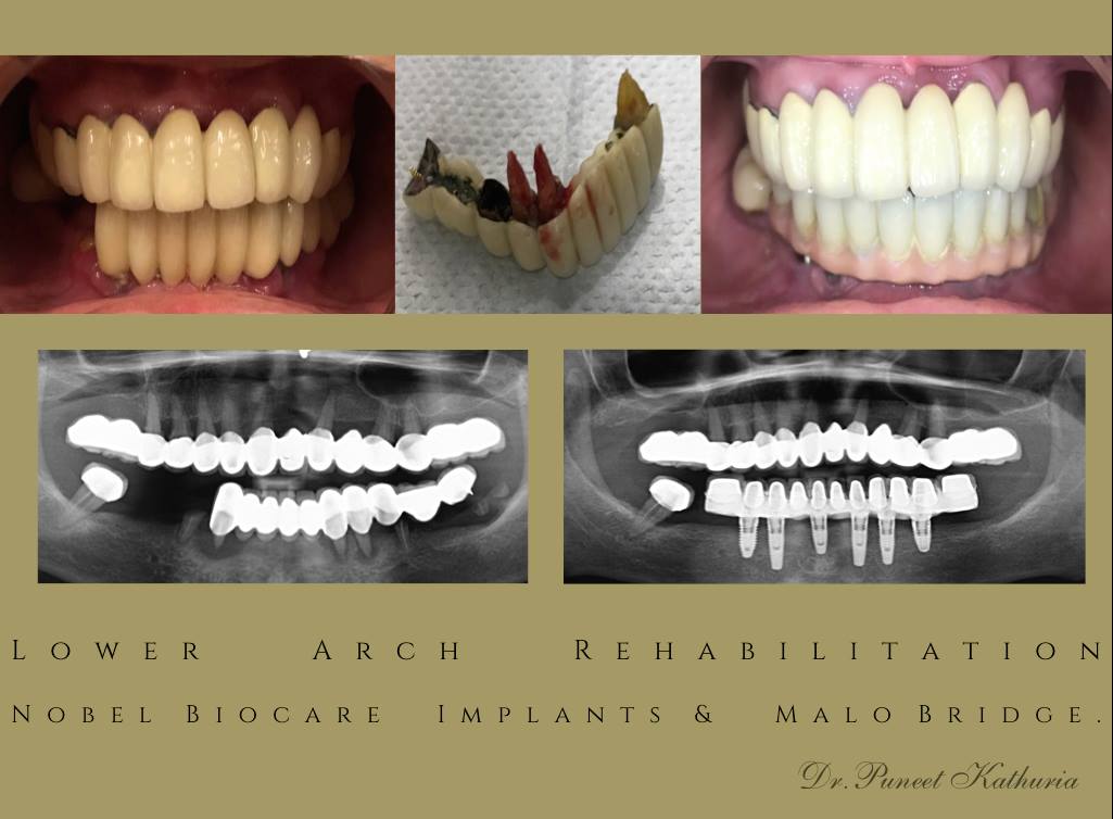 Lower Arch Rehabilitation with 6 Nobel Biocare Implants & Malo Bridge