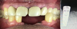 Lower front teeth replaced with dental implants and zirconia bridge - Before