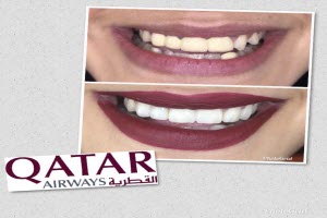 Smile Makeover - Qatar Airways - Small