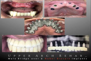 Upper Arch Rehabilitation - Small