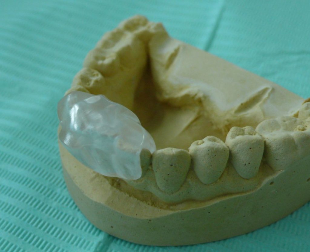 NTI Device Night Guard Night Guard Device