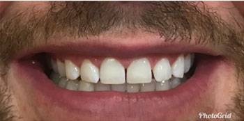 Zoom Teeth Whitening - After